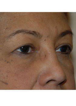 Before Image: Upper Eyelid and Browlift - right-front-oblique
