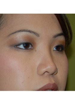 Before Image: Higher Nose Bridge - right-front-oblique