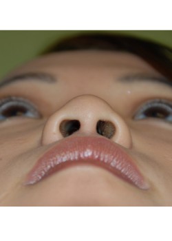 Before Image: Higher Nose Bridge - other